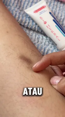 Siapa nih yang punya bekas luka menghitam gini??? Mending di pakein Meili beauty cream #bioherbal #meilibeautycream #bioherbalmeilibeautycream #bioherbalpenghilangluka #bekaslukahilang #pemudarbekasluka #darahmanis #bekasluka #bekaslukadikaki #bekaslukalama #bekaslukakoreng #penghilangbekaslukalama #penghilangbekasluka #beautyoil #pemudarbekascacar #bekasjerawat #bekasjerawathitam #bekasjerawatmemudar #bekasknalpot #bekaslukaknalpot #belilokal 