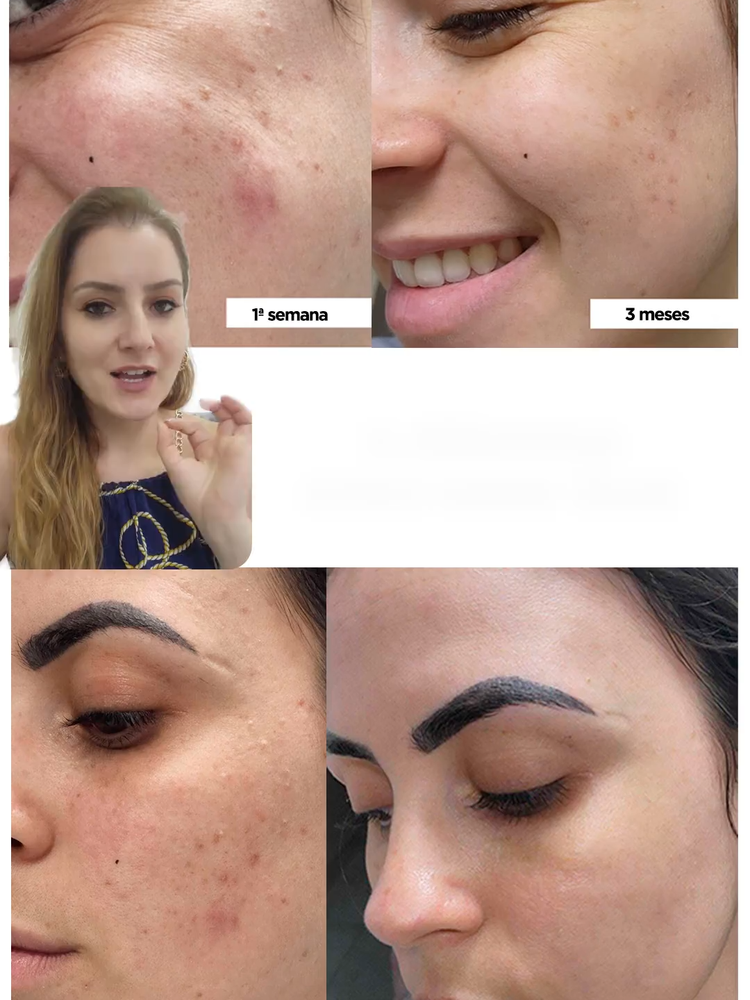 Acredite, é a mesma pessoa!  #colageno #rugas #manchasnapele