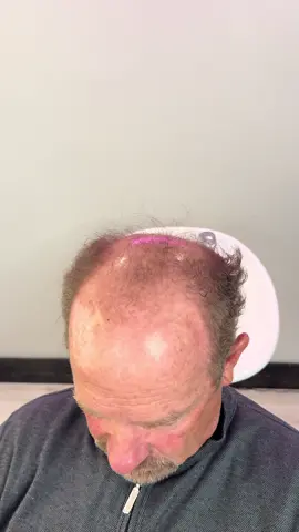 His smile is everything omg! . . . . . . . . . . #toupee #hair #saltlakecity #utah #newportbeach #california #bald #hairsystem #argylehair 