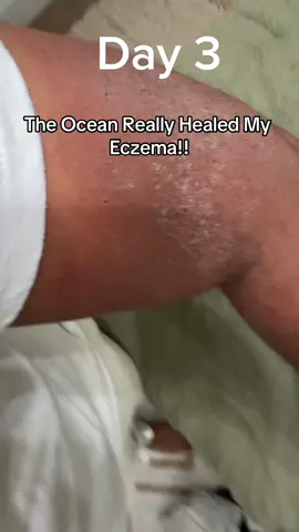 The Ocean Healed My Eczema in a Week! #ttsacl #tiktokshop #tiktokshopping #tiktokshopaffiliate #theoceanhealedmyeczema #eczema #oceanhealedmyeczema @Healed By The Ocean 