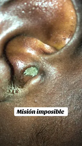 #miasis #oido #gusanos #infeccion #otica 