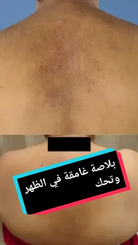 بلاصة غامقة في الظهر مع حكة ؟  داء النشواني Amylose maculeuse ما هو سبب بقعة سوداء في الظهر مع حكة ؟  #macularamyloidosis #طبيب_جلدية #امراض_جلدية #جلديه_و_تجميل #النشواني #حكة #بقع_داكنه 