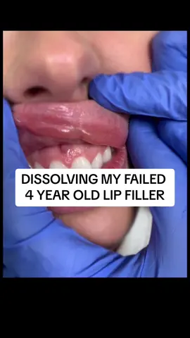 Lip dissolving #lipfiller #dissolving #lipdissolving #filler #hyalase #dissolvingfiller