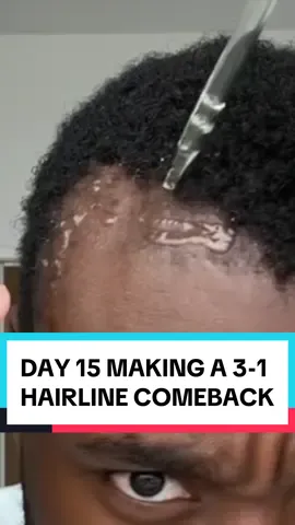 DAY 15 MAKING A 3-1 HAIRLINE COMEBACK 💪 #p2isthename 