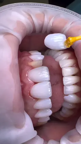 Emax Veneers  ✔️Your treatment will be completed in 5 days ✔️Dentist Consultation -Free ✔️Panoramik x-ray - Free ✔️Temporary Crowns during treatments - Free ✔️Removal of old Crowns - Free ✔️Medicine and Accompaniment - Free . . . . . . . . . . #veneer #veneers #zirconium#zirconiumcrown#dental #turkey#whitening#bleaching #emaxveneer #emax #smile #compositeveneers #composite