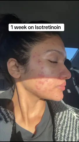 She’s getting better.  #acne #acnetreatment #skins #acneskin #tretinoin #accutane #acnefighter #acnepositivity 