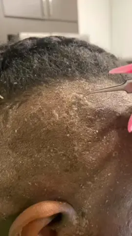 cara ampuh hilangkan ketombe membandel