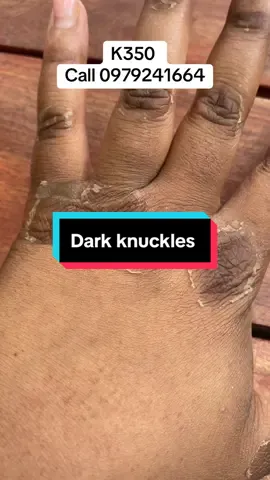 Don’t stress with dark knuckles, get the peeling oil. K350 per bottle call 0979241664 for orders. Don’t forget to stay hydrated, detox and apply your sunscreen. #knuckles #darkknuckles #skincareroutine #zambiantiktok🇿🇲 #skincare #fyp #southafrica #nigeriantiktok🇳🇬 #kenyantiktok #ugandatiktok #zedtiktok🇿🇲🇿🇲 #