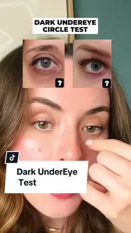 🌟✨ **Determine Under-Eye Discoloration Causes** ✨🌟 To understand whether under-eye discoloration is due to a #bloodcirculation issue or skin #discoloration, use this simple test:  Gently pinch and hold the skin under your eyes. If the discoloration lightens, it’s likely related to poor blood circulation. If it remains, it may be due to pigmentation or other skin issues. This method helps you tailor your approach to #skincare and treatments effectively. 🌿💆‍♀️ #UnderEyeCare #HealthySkin #AllYouCanFace 