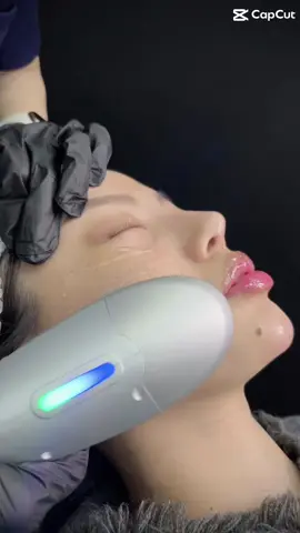 Hifu là phương pháp trẻ hóa làn da, khắc phục các khuyết điểm như lão hoá da, nâng cơ, giảm nếp nhăn,... Công nghệ hifu sử dụng sóng siêu âm hội tụ cường độ cao giúp trẻ hóa da mặt, cải thiện nếp nhăn, da chảy xệ, thiếu hụt collagen,… mà không cần can thiệp phẫu thuật. Từ đó, thúc đẩy quá trình sản sinh collagen và elastin, phục hồi các liên kết da bị đứt gãy, giúp da săn chắc, đàn hồi hơn, những nếp nhăn, vết chân chim, rãnh cười sâu cũng dần được làm đầy. Điểm đặc biệt của công nghệ này là bước sóng siêu âm hội tụ không gây bỏng rát, sưng tấy mà rất dịu nhẹ, không gây kích.#phongkhamdalieuqclinic #xuhuong #pkckdalieuqclinic #hifu 