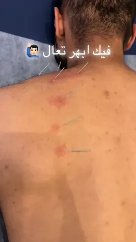 #viralbeauty #electric #therapy #trend #ترند #electrotherapy #explore #اكسبلور #علاج_طبيعي #physicaltherapy #drycupping #حجامة #حجامة_جافة #physiotherapy #عيادة #يوميات #تخفيضات #riyadh #علاج #dryneedling #الابر #الابر_الجافة @munira kadi 