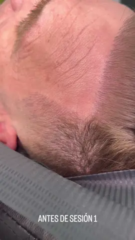 Micropigmentación capilar línea frontal. ##injertocapilar #trasplantecapilar #densidadcapilar #trasplantecapilarestambul #trasplantecapilarvalencia #trasplantecapilardhi #trasplantecapilarespaña #trasplantecapilarfue #micropigmentacioncapilar #valenciaespaña🇪🇦 #faltadedensidadcapilar 