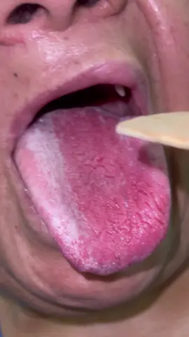 Candidiasis oral 🍄 #doctorexplains #doctor #medicine #consultamedica #pepe_pepp #fypシ #candidaalbicans #candidiasisoral #parati 