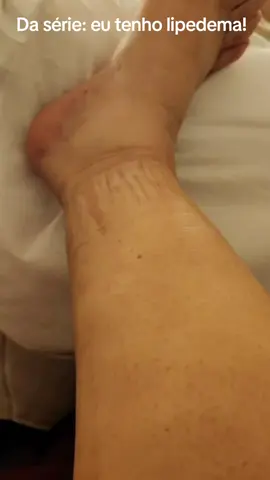 Você já ouviu falar em Lipedema?! #lipedema 