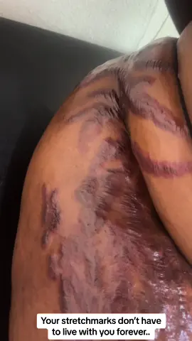 #tiktokcameroon🇨🇲tiktokafrica #stretchmarkremoval #stretchmark #microneedling 