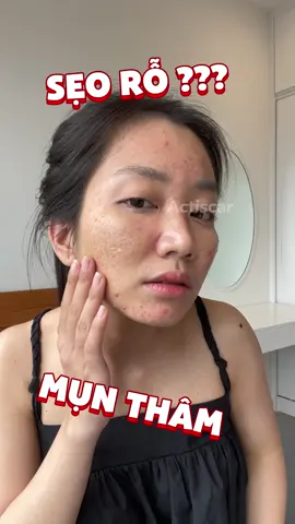 “Giải cứu” làn da khỏi Sẹo Rỗ - Mụn - Thâm với kem sẹo Actiscar