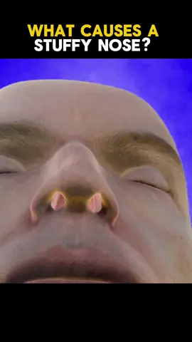 What Causes A Stuffy Nose? #stuffy  #stuffynose  #nose #stuffynosegoaway #medical #animation 
