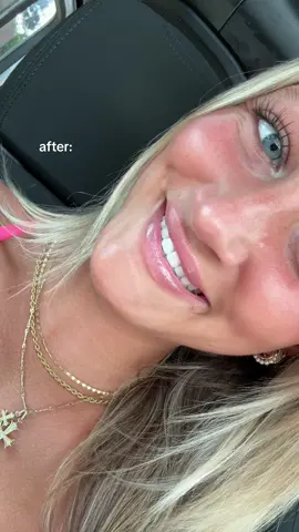 lip flip & filler love!! 💋💋💋 @Dr. Effie Politis 