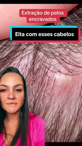 Sera que é so pelo? #cravos #limpezasatisfatoria #reagindo 