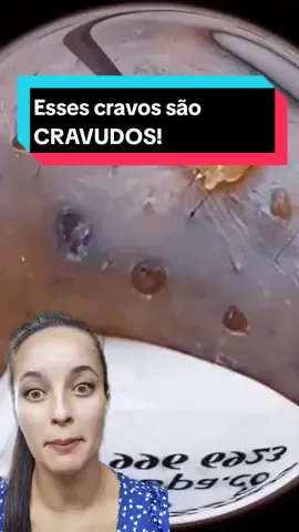 Cravos gigantes!! #cravos #tratamento #reagindo #videosatisfatorio #limpezasatisfatoria 