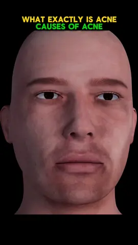 What Exactly Is Acne, Causes of Acne: 3D Animation #acenewneutron  #acne #acnetreatment  #acneskin #acneproneskin 