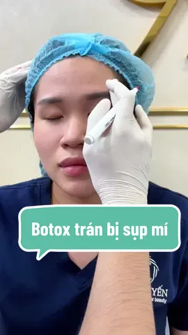 Botox trán bị sụp mí  
