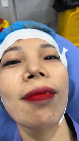 ANH TUYÊN ƠI MŨI EM THẾ NÀY CÒN SỬA ĐƯỢC NỮA KHÔNG ?#xuhuong #LearnOnTikTok #nangmui #nangmuiphongthuy #nangmuisline #nangmuicautruc 