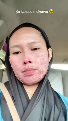 #creametiketbiruabalabal #sumbatanporipori #poriporikotor #comedo #pejuangkulitsehat 