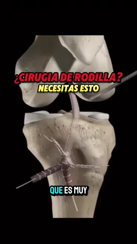 ❗️👇🏽TE CUENTO MÁS 👇🏽❗️ 👉🏼 Tras una cirugía de rodilla, uno de los movimientos importantes a recuperar es la flexión. 🦿La rehabilitación del gesto, muchas veces, se puede alargar más de la cuenta o incluso no recuperar al 100%. 🏋🏽 En este vídeo te traigo un ejercicio para poder forzar los últimos rangos de movimiento. 🚨 Recuerda que este tipo de ejercicio tan directo sólo debería ser utilizado en el final de tu recuperación. ❕SIGUEME PARA PODER ALIVIAR TU DOLOR Y RECUPERARTE CON MIS VÍDEOS DE FORMA GRATUITA ❕ #fisioterapia #fisio #dolor #dolorcronico #dolorcervical #dolordeespalda #rehabilitacion #anatomia #anatomiahumana #ejercicio #Fitness #manguitorotador #hombro #ciática #lesión #terapiamanual #manipulacionvertebral #menisco #cervicales #dolordebrazo #cervicobraquialgia #hernia #lumbago #lumbalgia 