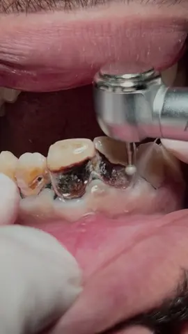 Deep tooth caries #dentist #teeth #dental #dentista #tartar #calculus 
