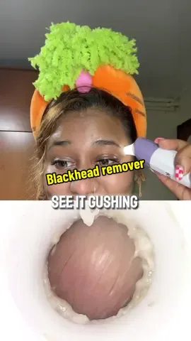 This is so good that it removes my entire facial junk and it felt so so so good!! What are you waiting for?? Incorporate this during your skincare or facial routine!! #blackhead #blackheads #blackheadsremoval #blackheadsss #blackheadsremover #fyp #blackheadsremovalmask #facial #facialrejuvenation #face #facereveal #facemask #viral #device #skindevice #skincare #skincareroutine #skincaretips #SkinCare101 #skintificid #createtowin #CapCut 
