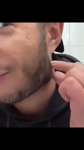 @satisfy.pimple Blackheads and Cyst popping! Vote the best one 🗳 #pimplepoppersatisfying #pimple #blackhead #acne 