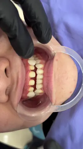 Gắn răng sứ thẩm mỹ cao cấp LavaPlus #NhakhoaMinhNgọc #BeautyDentalClinic #RăngSứ