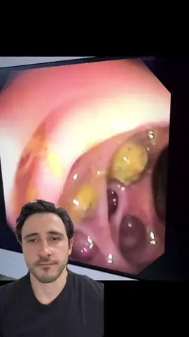 🔍 Diverticulite: O que Você Precisa Saber! 🔍 A diverticulite ocorre quando pequenas bolsas que se formam nas paredes do intestino, chamadas divertículos, ficam inflamadas ou infectadas. Esta condição pode ser bastante dolorosa e é importante saber identificar e tratar corretamente. 🎯 Sinais Clínicos e Sintomas: •	Dor abdominal, geralmente no lado esquerdo •	Febre •	Alterações nos hábitos intestinais •	Náuseas e, às vezes, vômitos 📸 Diagnóstico por Imagem: •	Tomografia Computadorizada (TC): é o exame padrão ouro para diagnóstico, mostrando inflamação dos divertículos, espessamento da parede intestinal e possíveis complicações como abscessos ou perfuração. •	Radiografias: menos informativas mas podem mostrar sinais de obstrução ou perfuração intestinal. 💡 Tratamento: •	Varia de antibióticos a, em casos graves, cirurgia. •	Mudanças dietéticas e aumento da ingestão de fibras são recomendados para prevenir recorrências. 🤔 Por Que Isso Importa?: Conhecer os sintomas e tratamentos da diverticulite é crucial para manejar eficazmente os episódios agudos e prevenir complicações sérias. 👍 Achou a informação útil? Dê um like, salve para referência e compartilhe com quem pode se beneficiar dessas informações! 💬 Teve alguma experiência com diverticulite ou tem dúvidas? Comente abaixo! Vamos aprender juntos! 🤗 Até a próxima! #medicina #internato #residenciamedica #foryou #foryoupage