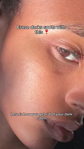 Here’s how to erase dark spots 👀❣️ #skintok #hyperpigmentation #kojicacid 