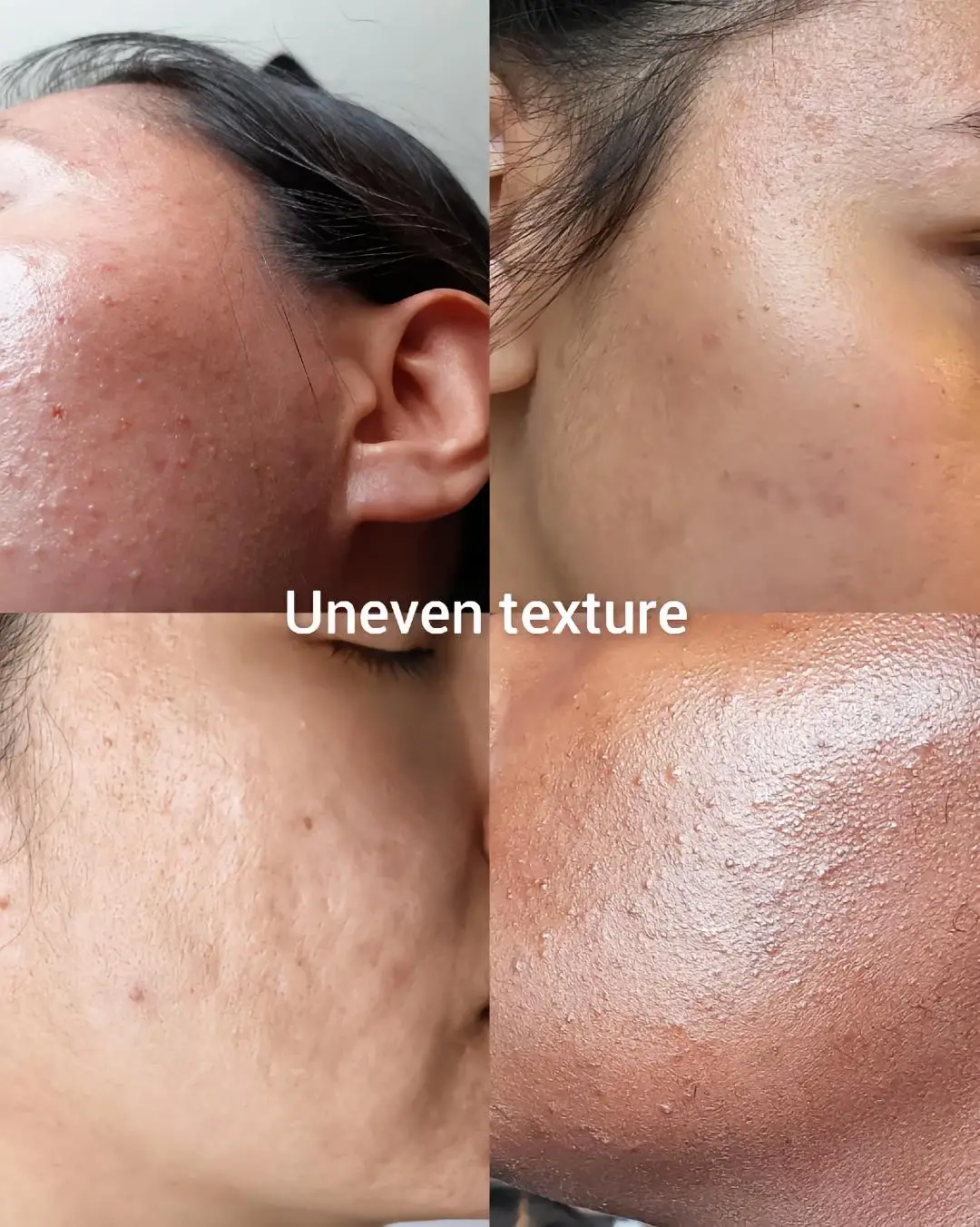Skin Condition. Check yours and check my videos for skincare tips ✨✨ #skincare #skincondition #acne #acnetreatment #skincaretip #fyp #purgin #cloggedpores #uneventexture #stressacne #hormonalacne 