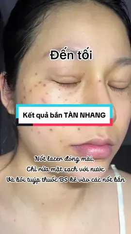 Kết quả bắn tàn nhang chỉ 1 lần là hết