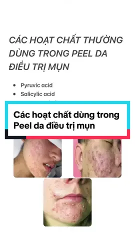 Các hoạt chất thường dùng trong Peel da điều trị mụn #spa #dieutrimun #chuanykhoa #dieutrida #metaskinacademy #bacsingovanhoa 