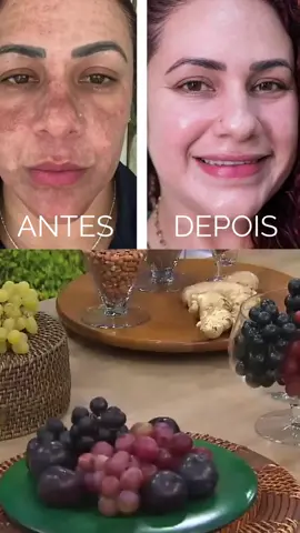 O Trans Resveratrol tem combinação perfeita,você só irá precisar tomar 12 gotas por dia em jejum o tratamento será de dente pra fora.A absorção é rápida e todo produto é aproveitado. Nele contém vitamina k2 ácido hialurônico!!!#cuidadocomapeledorosto#nuncamaispedegalinha #transresveratrolgota 