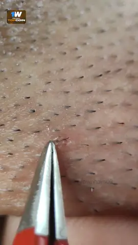 #satisfyingremoval #ingrownhairpull #ingrownhair #asmr #relax 