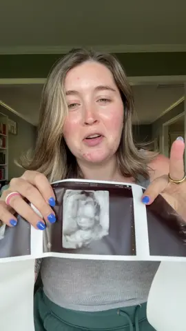 Makes me even more excited for October to be here 🥹🩵 #anatomyscan #20weekspregnant #20weekscan #ultrasound #pregnancyupdate #firsttimemom #newmom #pregnant #pregnantlife #pregnancyjourney #pregnancytiktok #pregnanttiktok  Anatomy scan  20 week scan  Pregnancy  First time mom  Pregnant life  Pregnancy update 