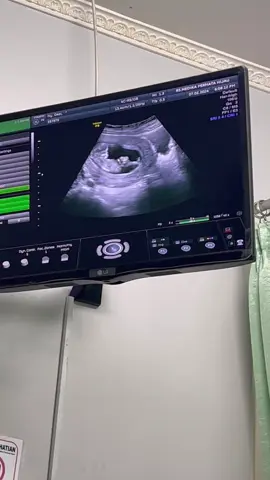 Masya Allah Tabarakallah... Bayi 3 bulan aktif bgtnii diperuut👶✨ #pregnant #USG #babydragon #13weeks #babykicks 