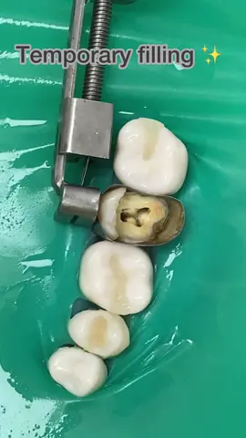 Thats a big filling! Ideal treatment would be a zirconia crown after RCT is completed 🦷 👑 #caries #decay #endodontics #dentistry 