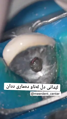 سەنتەری میردێنت بۆ جوانکاری و پزیشکی ددان   ناونیشان: گۆڕەتوو بەرامبەر تیممارت  07503553668   ☎️ #foryou #orthodontics #hollywoodsmile #کیفی_ددان #smile  #soran #mergasor #چاندنی_ددان #جوانکاری_ددان #ڕاستکردنەوەی_ددان_بە_قستی_مانگانە #مێرگەسۆر_بارزان #مێرگەسۆر #soran #mergasor #چاندنی_ددان #جوانکاری_ددان #ڕاستکردنەوەی_ددان_بە_قستی_مانگانە #مێرگەسۆر_بارزان #مێرگەسۆر  @MEERdent 🦷 میردێنت  #fyp #fypシ゚viral #viral #insane #دڵ 