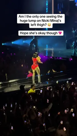Am I the only one seeing the huge lump on Nicki Minaj’s left thigh? 😳 Hope she’s okay though 💖 #nickiminaj #londonconcert #nickiminajliveinlondon 