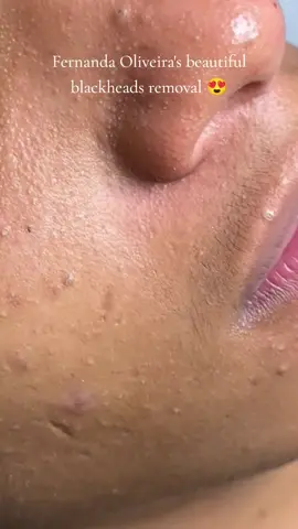 Fernanda Oliveira's beautiful blackheads removal 😍 #blackhead #pimple 
