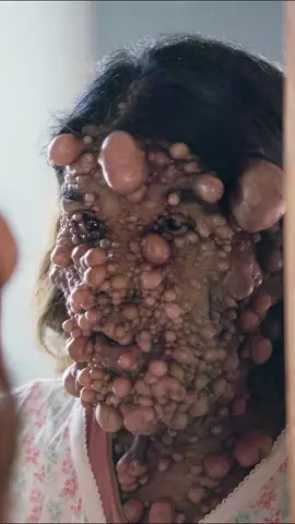 Charmaine condition is very extreme and rare😳😲🙏 #fyppppppppppppppppppppppp #tiktok #instadaily #viral #trending #trending #fypage #fypシ゚viral #believe #episode #tlc #borndifferent #wow #doctor 