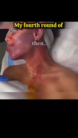 My fourth round of Laser Treatment on my #disease #tiktok #doctor #goodthing #kidney #stone #Science #positivevibes #news #tecnology #design #kidneyfailure #viralvideo #disease #school #success #Science #foryoupage #foryou #viralvideo #viral 