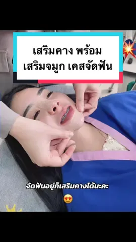 จัดฟันอยู่ก็เสริมคางได้น้าาา ✨  #เลอโชเม่คลินิก #lechomeclinic #รีวิวบิวตี้ #รีวิวบิวตี้ในtiktok #คลินิกเสริมความงาม #tiktokป้ายยา 