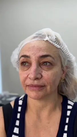 Full face only fillers